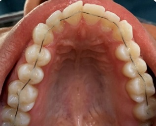 Coluna Ortodontia e Ideias – Técnica híbrida para tratamento de Classe I com apinhamento – relato de caso