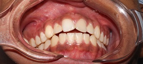 Ceratocisto odontogênico em maxila com deslocamento dentário para assoalho de órbita – relato de caso