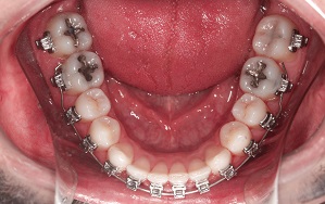Correção da mordida cruzada posterior bilateral em paciente classe III por compensação dentoalveolar – relato de caso