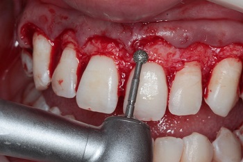 Inter-relation between Restorative Dentistry and Periodontics – case report