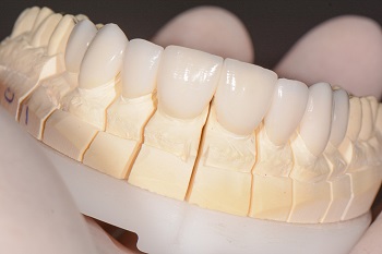 Cirurgia plástica periodontal, pela técnica flapless, associada aos laminados cerâmicos para a correção do sorriso – relato de caso