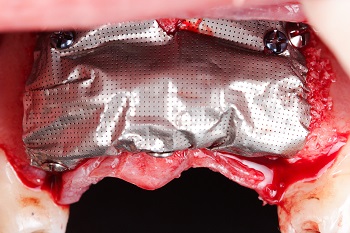 Aumento horizontal alveolar de maxila atrófica utilizando malha de titânio associado ao parafuso tenda e enxerto xenógeno – relato de caso