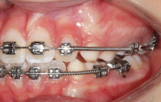 Interceptação da mordida aberta anterior na dentição mista – relato de caso
