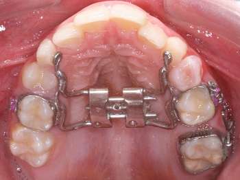 Coluna Point of View – Como distalizar o primeiro molar superior permanente na dentição mista ancorado em disjuntor palatal?