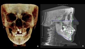 Traumatismo dentário de incisivos superiores em pacientes da Clínica de Ortodontia da UFRJ: prevalência e fatores predisponentes dentofaciais
