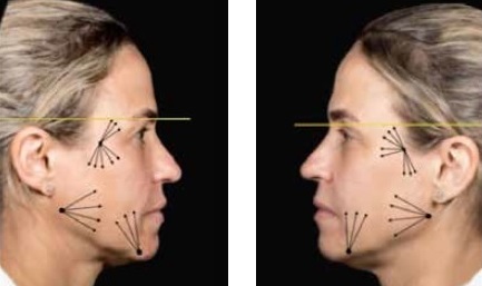 A ação da hidroxiapatita de cálcio no rejuvenescimento facial – relato de caso
