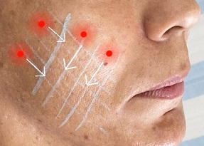 Tratamento de cicatriz de acne utilizando fios de polidioxanona associados à i-PRF – relato de caso