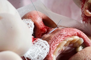 Eversão labial cirúrgica através da técnica subnasal de lip lift – relato de caso
