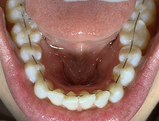 Coluna Ortodontia e Ideias – Uma nova perspectiva na Ortodontia, tratamento híbrido 3DBOT e alinhadores – relato de caso