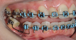 Verticalização de molares com a utilização do bráquete Duplo Slot – relato de caso