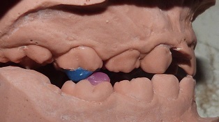 Filosofía PDM: actuación general en ortodoncia interceptiva