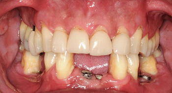 COLUNA JAQUES – Implantes ancorados na tuberosidade maxilar com carga imediata