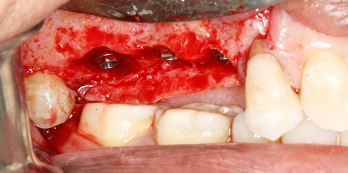 COLUNA GROIS – Osteoplastia em região posterior de maxila associada à instalação de implantes – relato de caso
