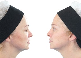 Fios absorvíveis de polidioxanona para procedimentos estéticos de rejuvenescimento da face – relato de caso