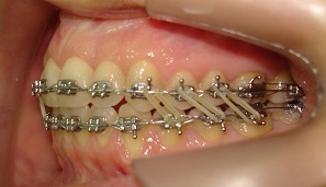 Atresia maxilar associada à mordida aberta anterior tratada por meio de expansão rápida da maxila assistida cirurgicamente (ERMAC)