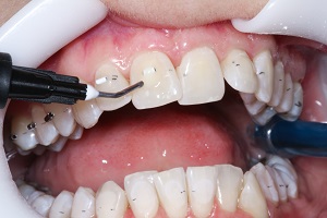 Aligner Tubes – a new option for orthodontic correction without the use of brackets