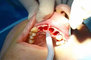 Relação do desenvolvimento de doença periodontal na presença de tratamento ortodôntico