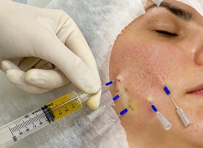 Tratamento de cicatriz de acne com peelings, subcisão, fios de polidioxanona (PDO) e fibrina rica em plaquetas – relato de caso