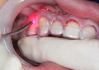 Cirurgia periodontal guiada – fluxo digital para correção de sorriso gengival