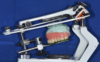 Remontagem clínica e ajuste oclusal de próteses totais convencionais em articulador semiajustável