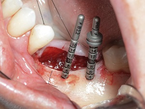 Reabilitação de mandíbula absorvida com implantes colocados através de dente incluso próximo à estrutura anatômica – relato de caso com acompanhamento de 5 anos
