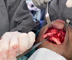 Tratamento tardio de fratura de sínfise mandibular por abordagem extraoral – relato de caso