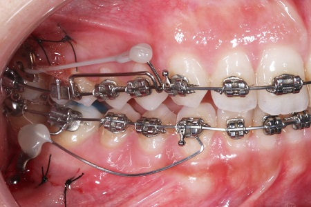 Coluna Point of View – Miniplacas em Ortodontia. Quando, como, por que e para quê?