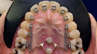 Coluna Ortodontia e Ideias – Ortodontia estética, ancoragem esquelética em casos cirúrgicos ortognáticos
