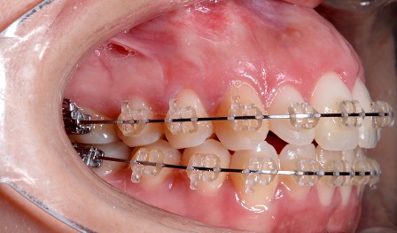 Tratamento orto-cirúrgico de paciente com sorriso gengival e padrão face longa – relato de caso