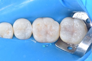 Carimbo oclusal e resina bulk-fill em restauração direta de dentes posteriores – relato de caso