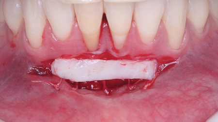 Coluna Informação e Tecnologia – Aumento de tecido queratinizado ao redor de dentes e implantes através do enxerto gengival livre