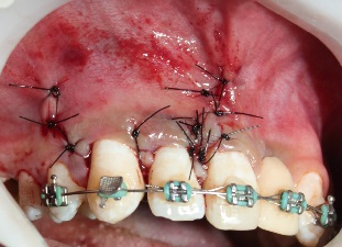 Remoção cirúrgica de dente supranumerário impactado em maxila