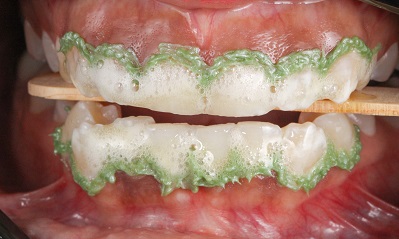 Abordagem minimamente invasiva para tratamento de fluorose dental com associação de técnicas