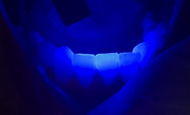 Traumatismo dentário em atleta – relato de caso de subluxação