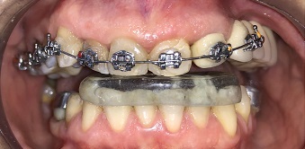 Tratamento compensatório da má oclusão de classe III em paciente adulto com mutilação dentária