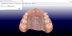Previsibilidade da expansão dentoalveolar em pacientes em dentadura mista com Invisalign First®