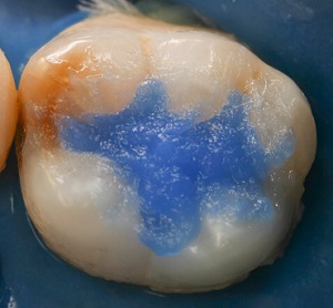 Tratamento restaurador de lesão de cárie oculta com uso da resina Bulk Fill associada à matriz oclusal – relato de caso