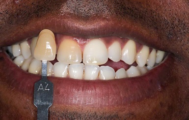 Tratamento endodôntico e estético de dentes calcificados – relatos de casos