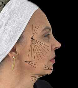 Utilização de ácido poli-L-láctico para o rejuvenescimento facial: relato de caso clínico