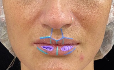 Preenchimento labial – relato de caso