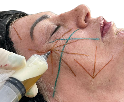 Bioestimulação facial com a utilização de ozonioterapia e IPRF – relato de caso