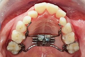 Point of View Column – Rapid maxillary expansion: a controversial technique or revolutionary advance in orthodontics?