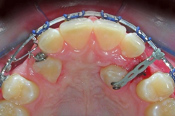Apicotomy – the last frontier for ankylosed impacted canine traction