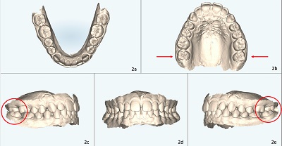 Deficiências biomecânicas dos alinhadores – dentes posteriores