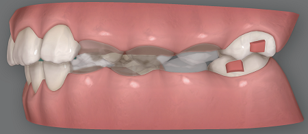 Ortodontia infantil: manejo de espaço na dentadura mista com alinhadores