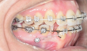 Coluna Ortodontia e Ideias – Correção de desvio de linha média dentária com o auxílio de ancoragem esquelética e extrações unilaterais – relato de caso