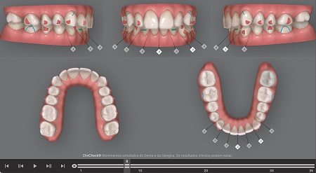 Tratamento da Classe II com distalização sequencial dos dentes superiores utilizando alinhadores Invisalign