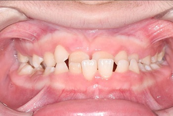 Padrão de anomalias dentárias em pacientes com síndrome de down: uma série de casos