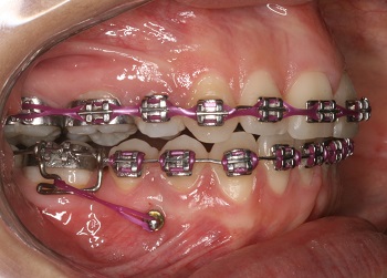 Asymmetric extractions for the treatment of asymmetric Class II malocclusion with anterior opening and posterior crossing and large superior midline deviation – case report