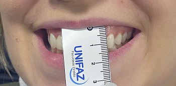Aplicação de toxina botulínica tipo A em paciente com sorriso gengival – relato de caso